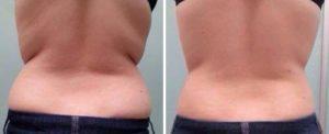 Before and After Image: Body Contouring - back