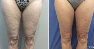 Before and After Image: Body Contouring - front