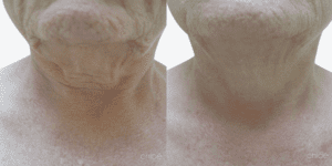 Before and After Image: Body Contouring - front
