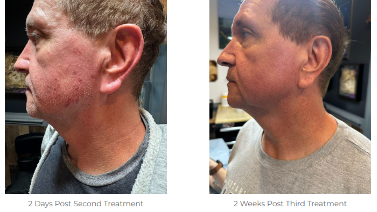 Before and After Image: Laser Vein TreatmentS - left-side